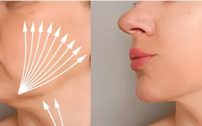 Hilos tensores: precisión, elegancia y naturalidad en el rejuvenecimiento facial